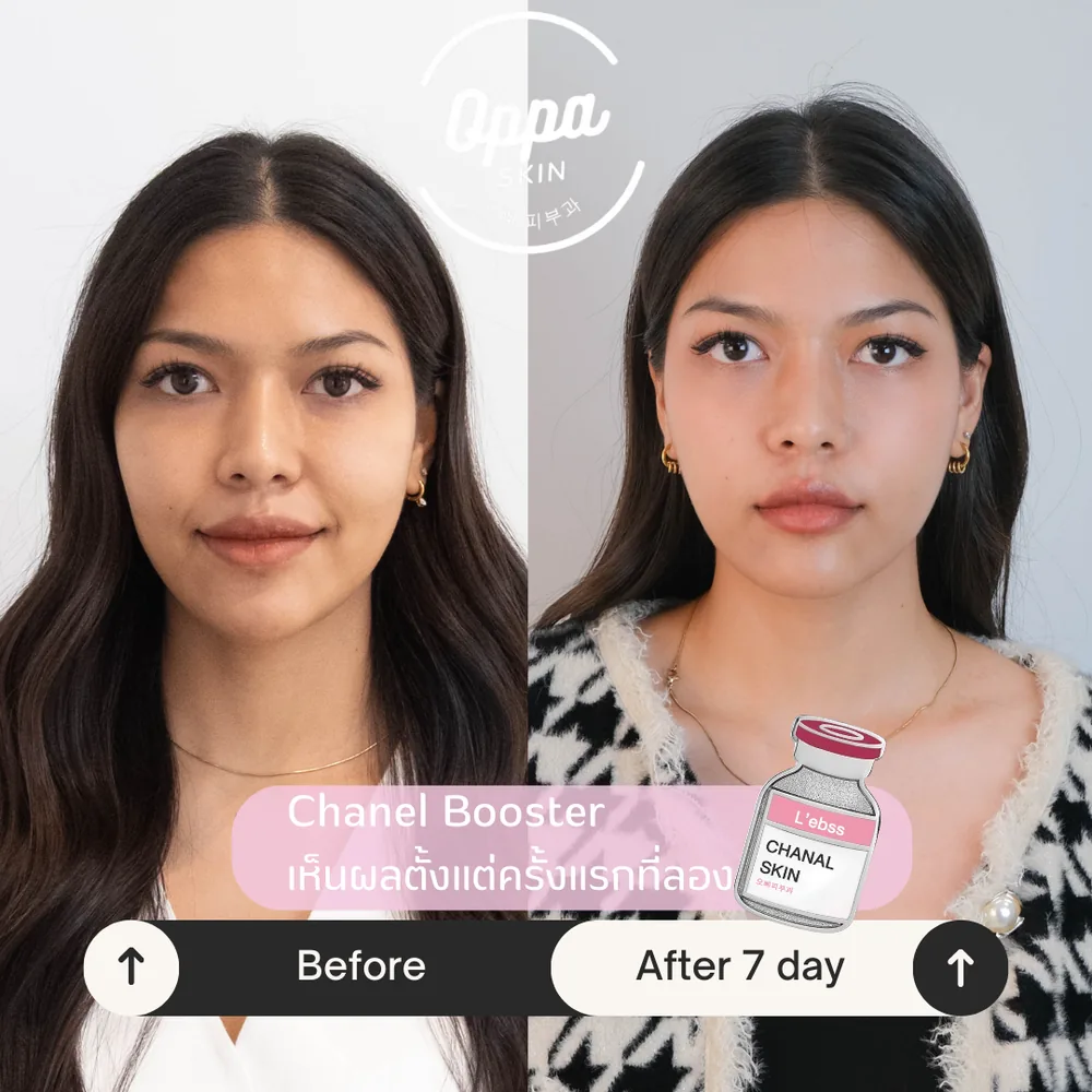 ตัวอย่างผลลัพธ์ Glass Skin + Skin Booster