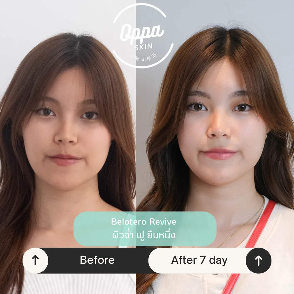ตัวอย่างผลลัพธ์ Filler (Natural Look)