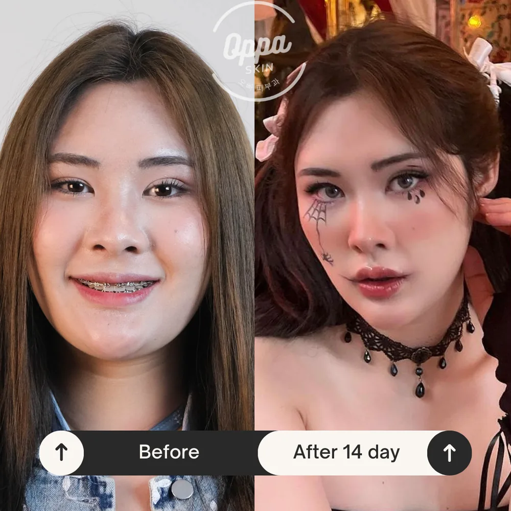 ตัวอย่างผลลัพธ์ Pico Laser