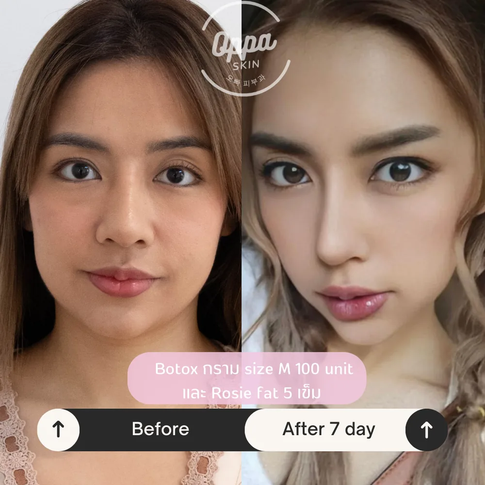 ตัวอย่างผลลัพธ์ Botox + Skin Booster