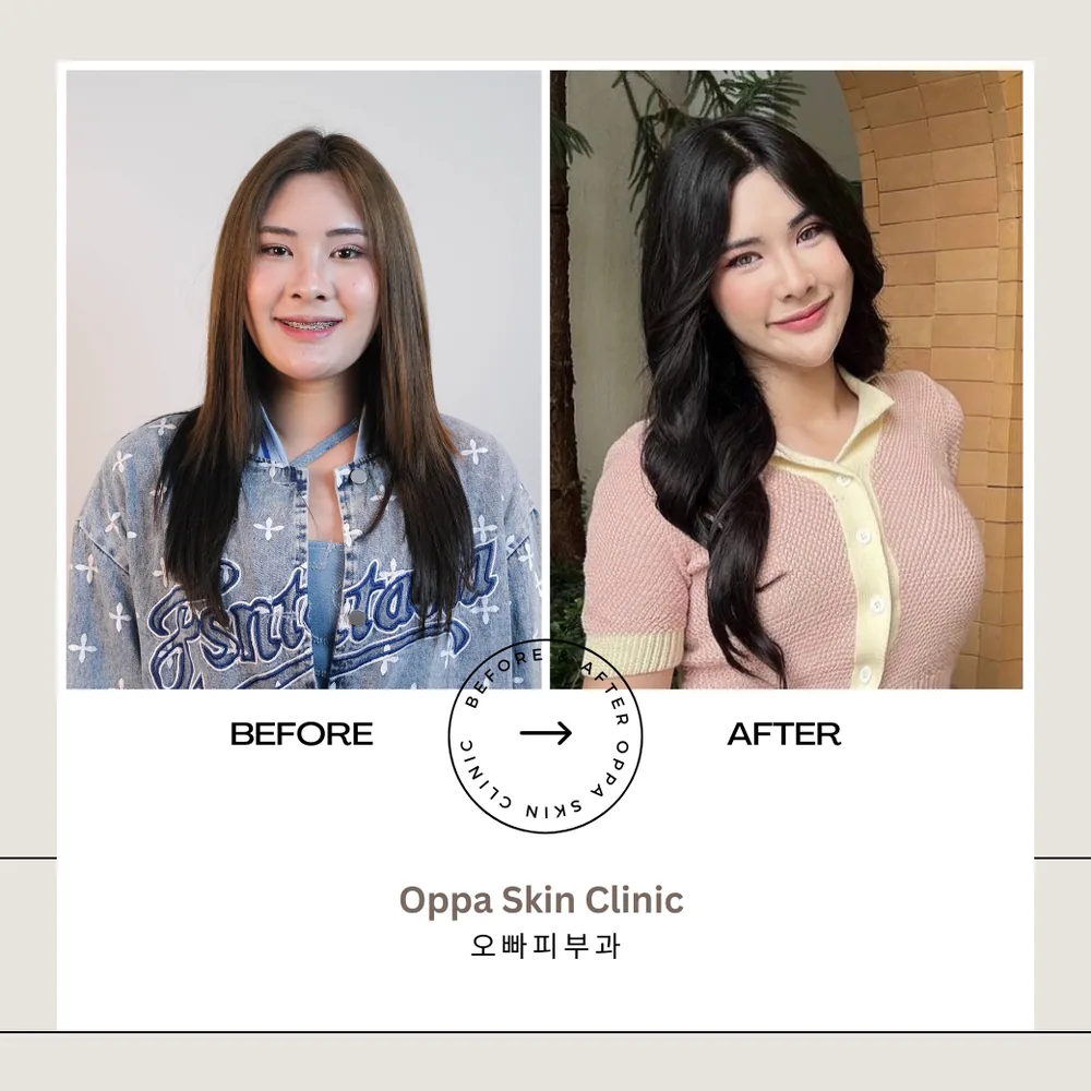 ตัวอย่างผลลัพธ์ Thread Lift + ดูแลต่อเนื่อง