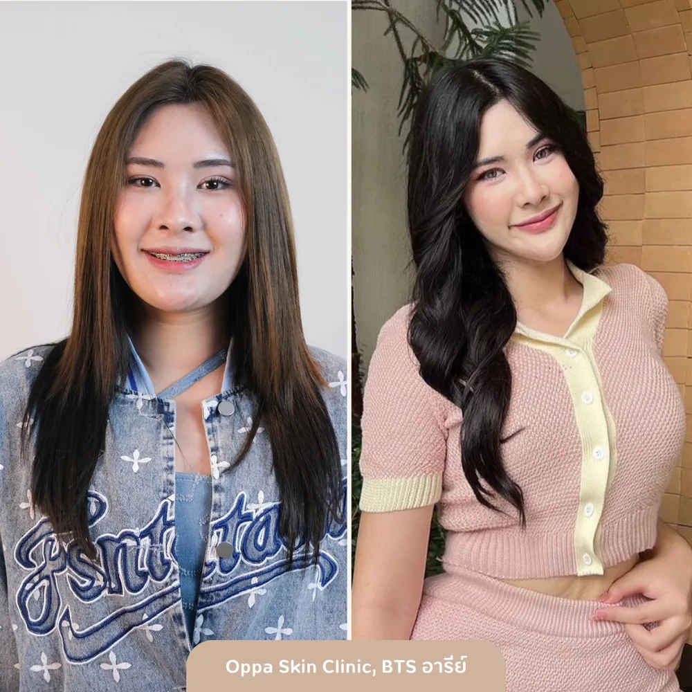 ตัวอย่างผลลัพธ์ Acne Care + Brightening