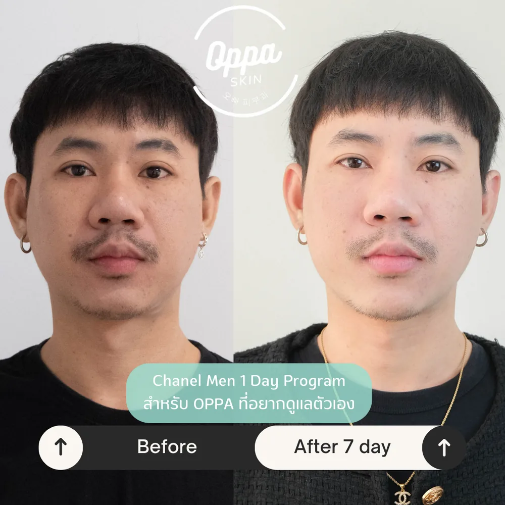ตัวอย่างผลลัพธ์ Laser + Glass Skin