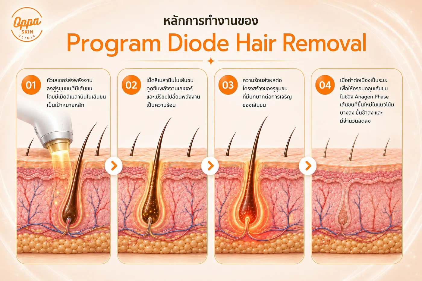 หลักการทำงานของ Diode Laser