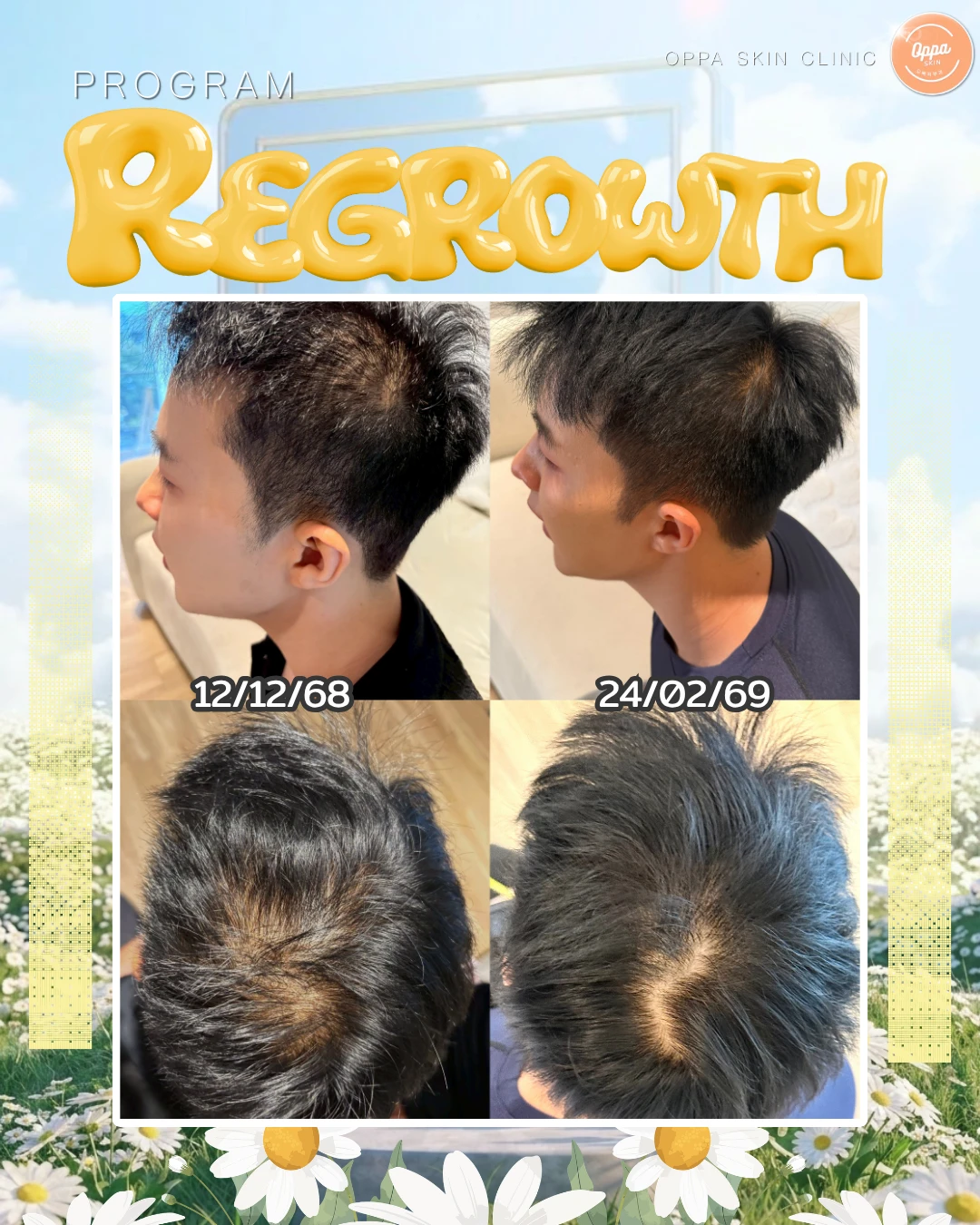 ตัวอย่างผลลัพธ์ โปรแกรม Regrowth (ผม)